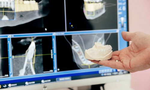 Zahnabdruck für die Herstellung eines Implantats vor Röntgenaufnahmen in der Praxis in Siegen