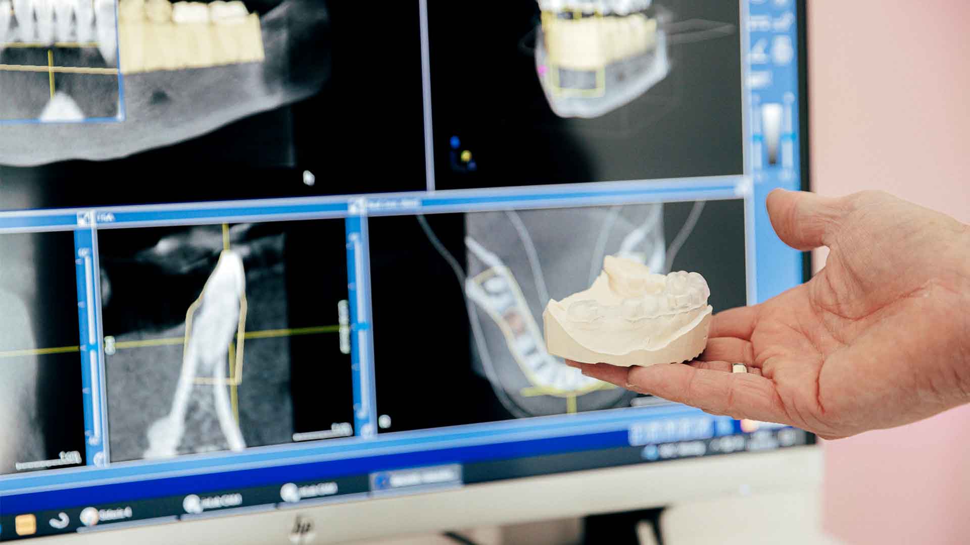 Zahnabdruck für die Herstellung eines Implantats vor Röntgenaufnahmen in der Praxis in Siegen